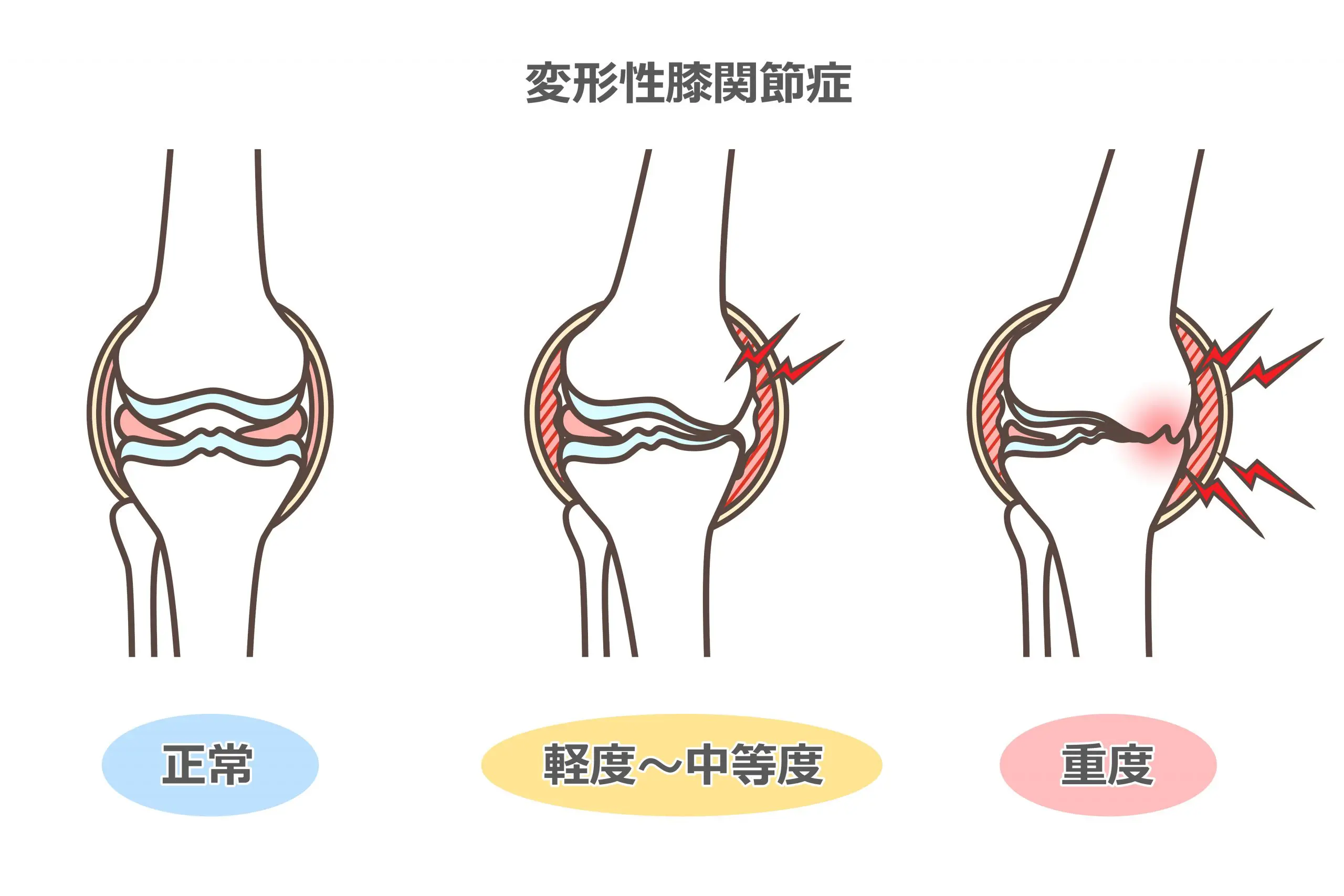 膝痛（変形性膝関節症）のリハビリ | いとしん整形外科